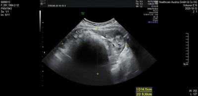 Case report: Squamous cell carcinoma and spindle cell sarcoma (SCS) arising in a mature cystic teratoma of the ovary